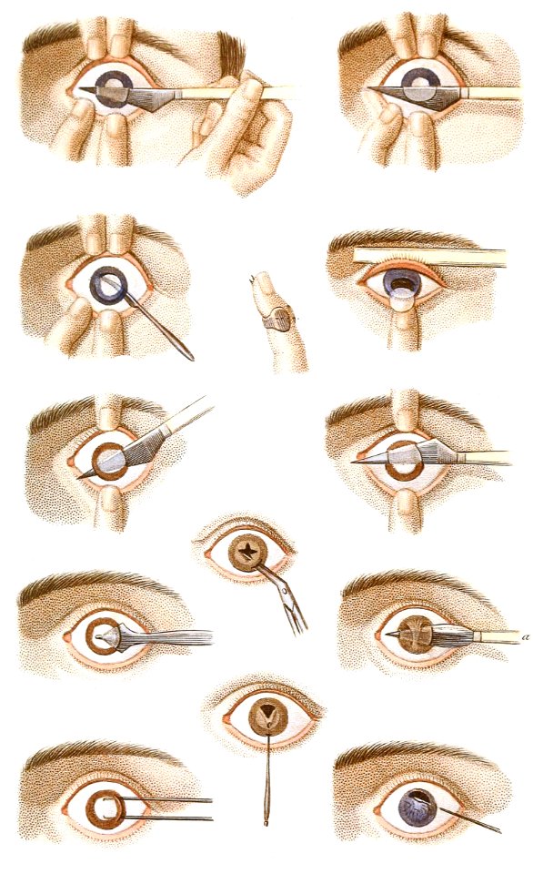 Cataract and Artificial Pupil