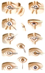 Cataract and Artificial Pupil