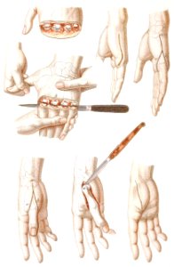 Disarticulation of the Four Fingers
