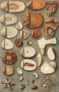 Kidney and Bladder Stones