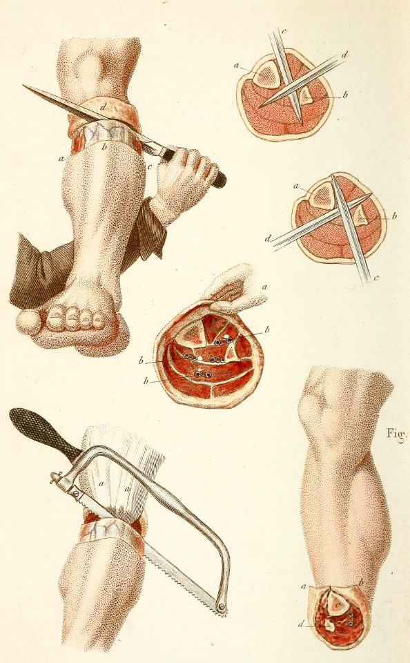 Amputation of the Leg