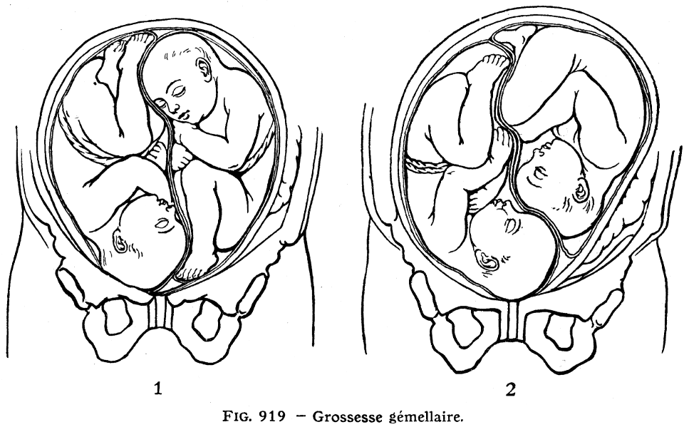 grossesse gémellaire