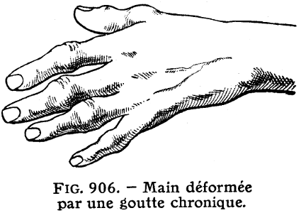 goutte chronique