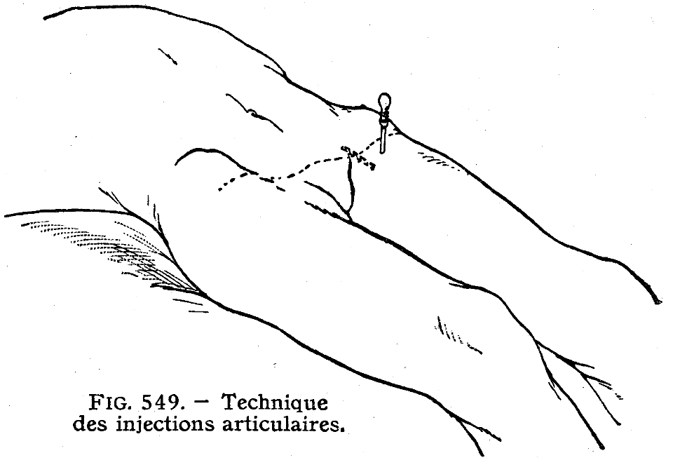 injection articulaire