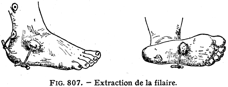 filaire-extraction