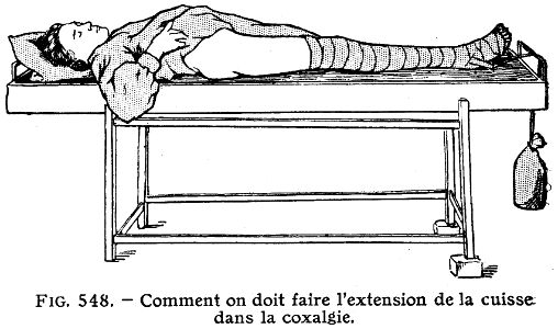 coxalgie-1