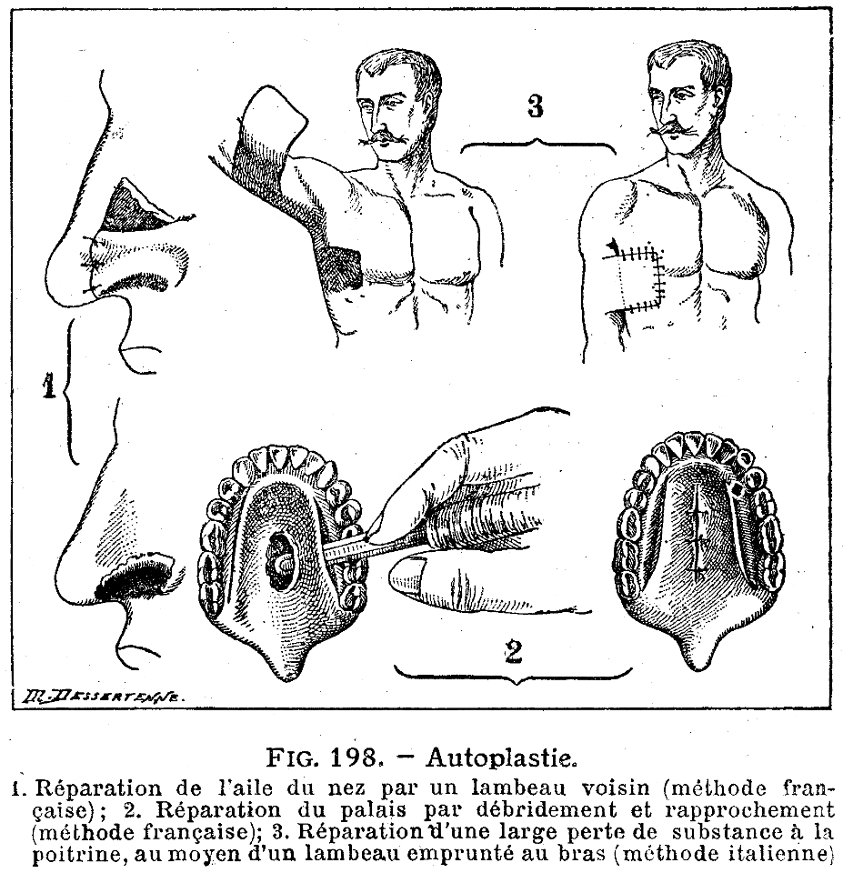 Autoplastie - Free Stock Illustrations 