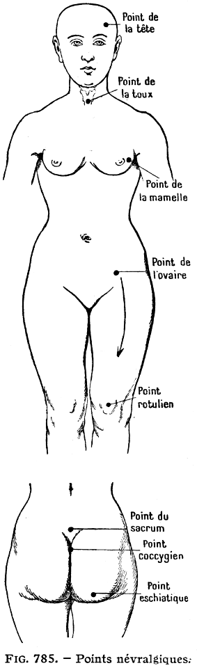 femme-points névralgiques