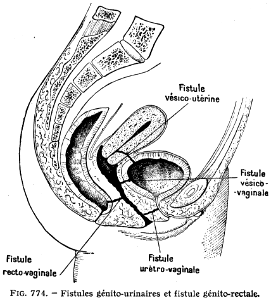 femme-fistules