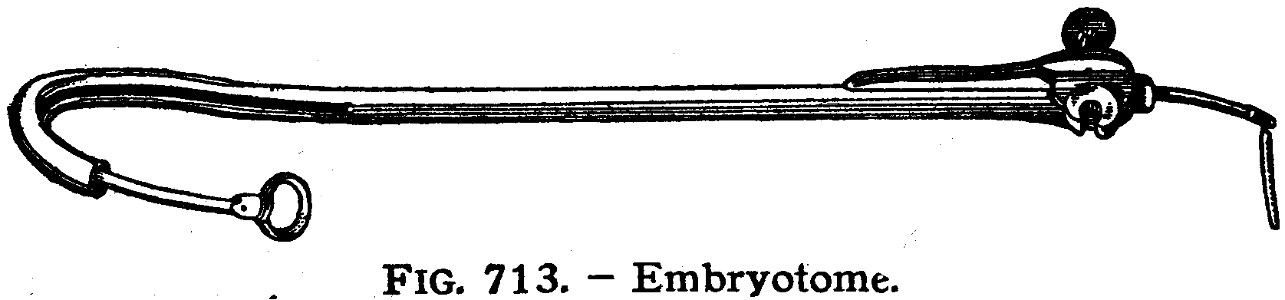 embryotomie