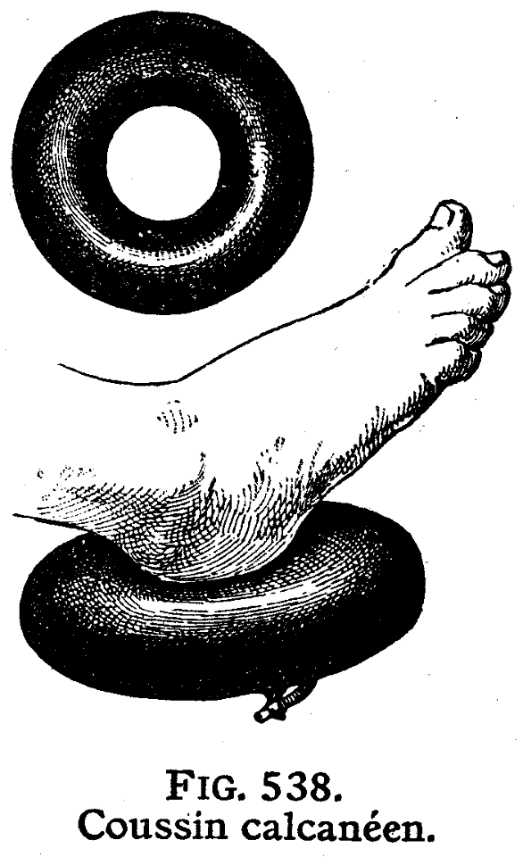 coussin calcanéen