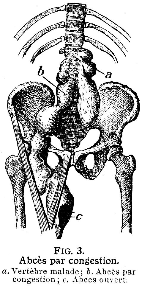 abcès