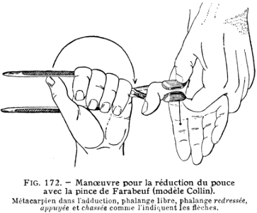 réduction du pouce