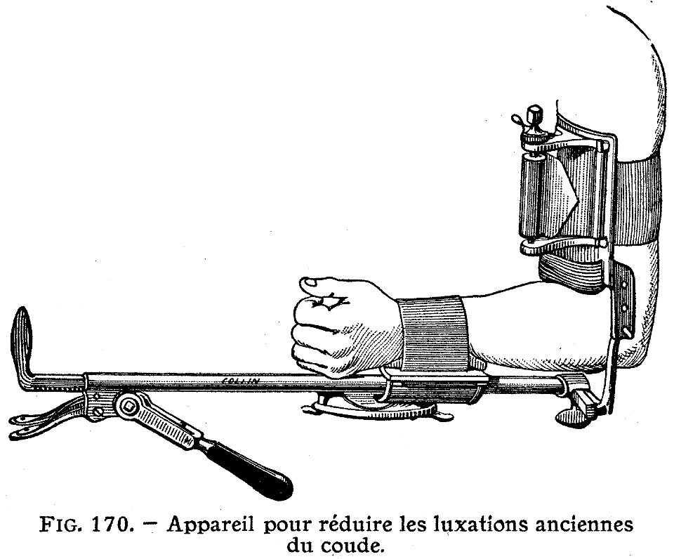 luxation du coude