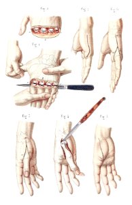 disarticulation-fingers-1600