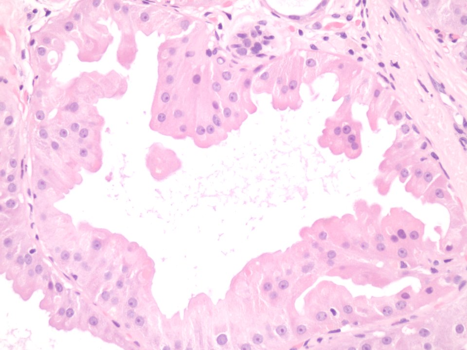 Enfermedad Fibroquística de la mama (metaplasia apocrina) (21835241313)