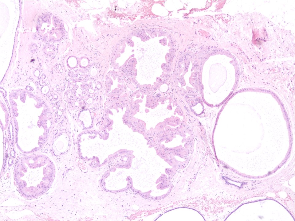 Enfermedad Fibroquística de la mama (22268777908)
