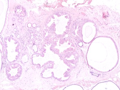 Enfermedad Fibroquística de la mama (22268777908)