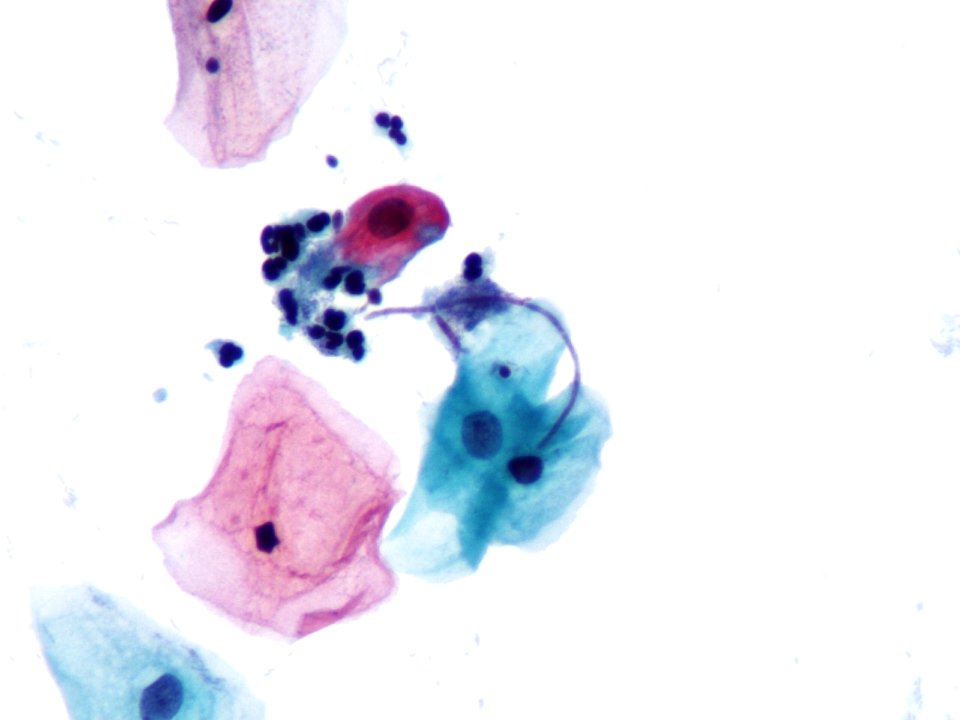 Hongos (citología vaginal) (9421168638)