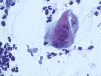 Infección vaginal por virus herpes (9358396491)