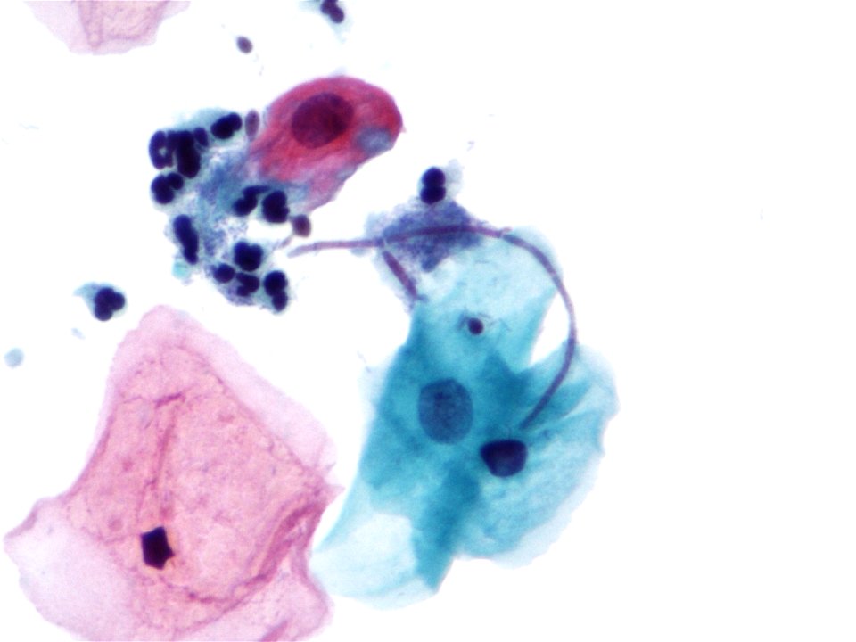 Hongos (citología vaginal) (9421168634)