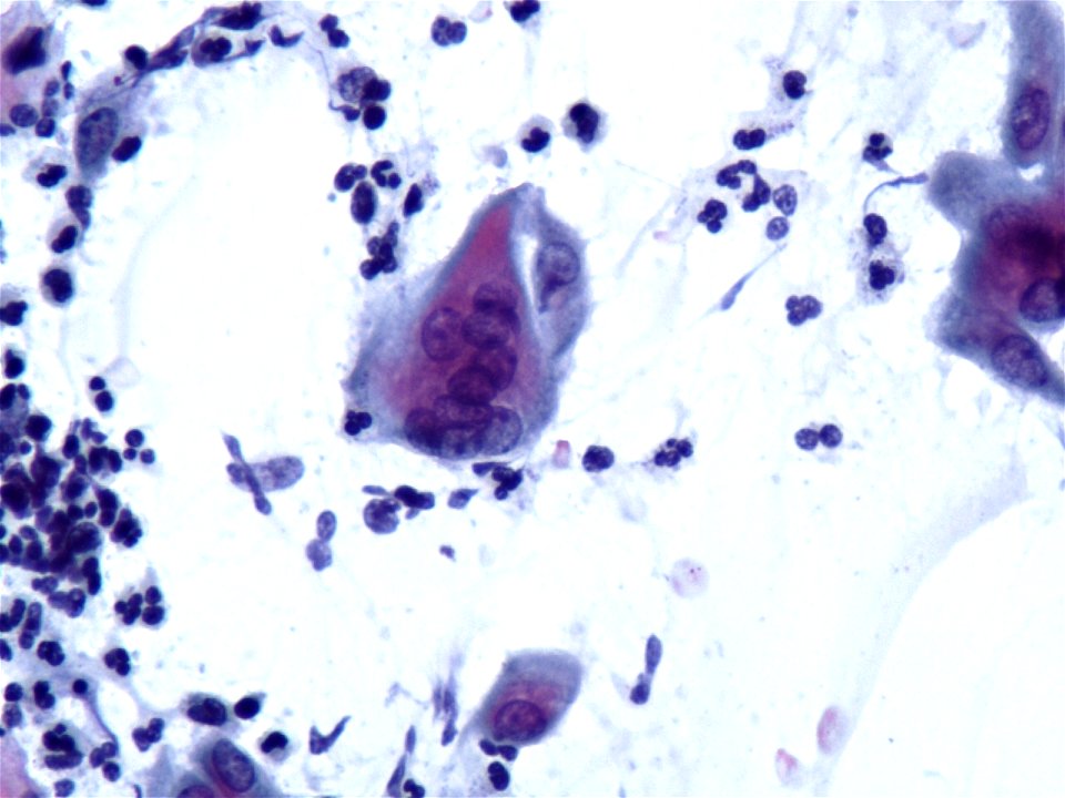 Infección vaginal por virus herpes (9361174718)