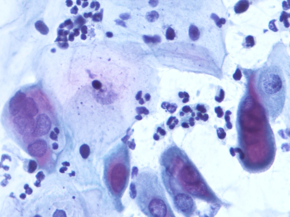 Infección vaginal por virus herpes (9361174736)