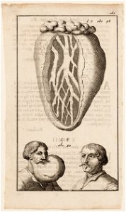 Afbeelding, fol. 161, blaas en man voor en na operatie van zijn gezwel, objectnr A 19451
