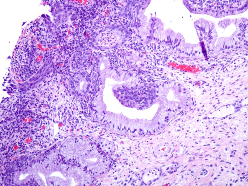 Lesión intraepitelial escamosa de alto grado (HSIL) (9321364682)
