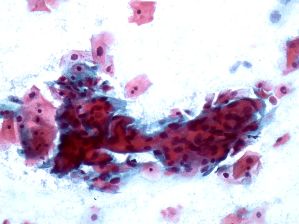 Lesión intraepitelial escamosa de alto grado (HSIL) (9391499068)