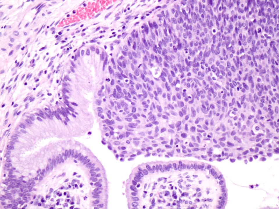 Lesión intraepitelial escamosa de alto grado (HSIL, CIN3) (9388755637)