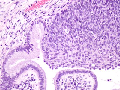 Lesión intraepitelial escamosa de alto grado (HSIL, CIN3) (9388755637)