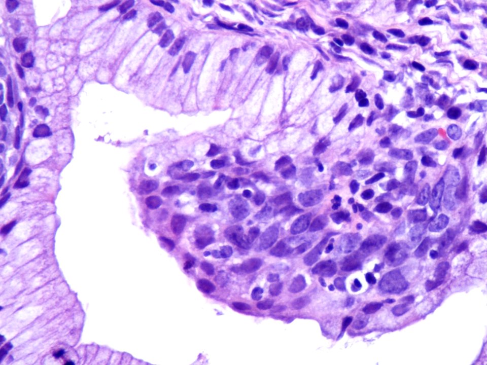 Lesión intraepitelial escamosa de alto grado (HSIL) (9318573621)