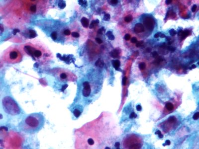 Lesión intraepitelial escamosa de alto grado (HSIL) (9388726153)