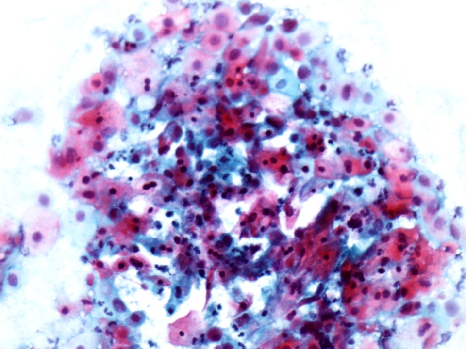 Lesión intraepitelial escamosa de alto grado (HSIL) (9391499184)