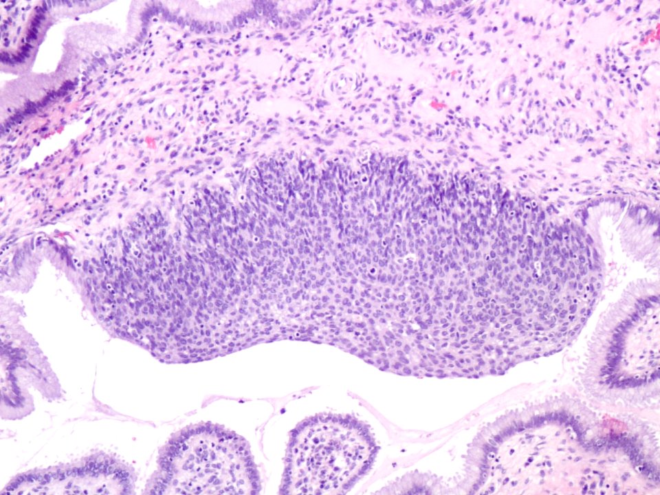 Lesión intraepitelial escamosa de alto grado (HSIL, CIN3) (9391529236)