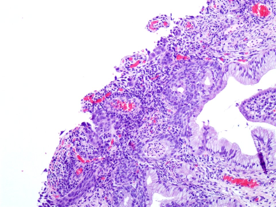 Lesión intraepitelial escamosa de alto grado (HSIL) (9321366386)