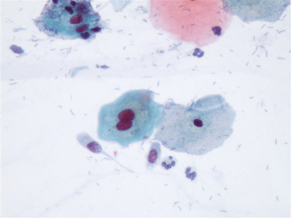 Lesión intraepitelial escamosas de bajo grado (LSIL) (9295343452)