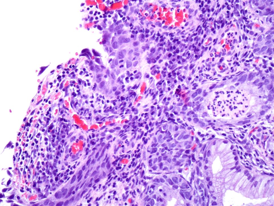 Lesión intraepitelial escamosa de alto grado (HSIL) (9321364476)