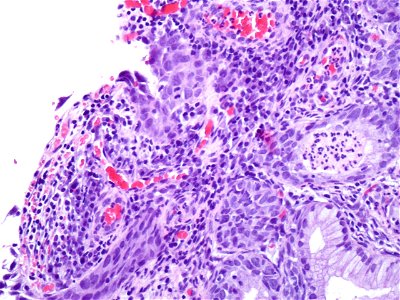 Lesión intraepitelial escamosa de alto grado (HSIL) (9321364476 ...