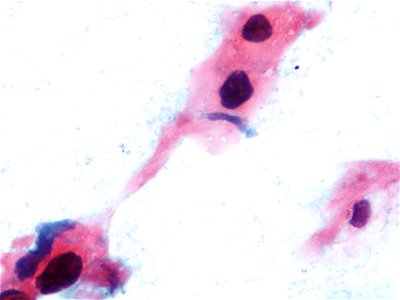 Lesión intraepitelial escamosa de alto grado (HSIL) (9388726691)
