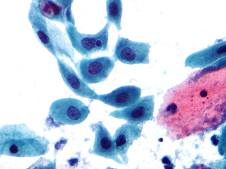 Metaplasia escamosa (cuello de útero) (9399641255)