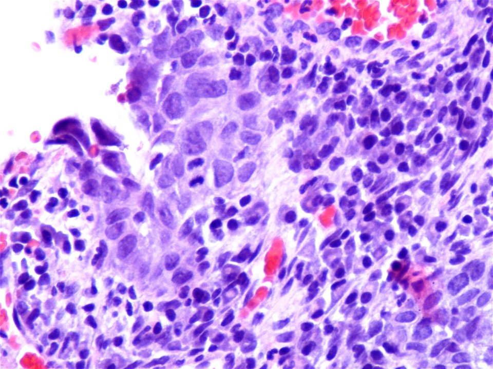 Lesión intraepitelial escamosa de alto grado (HSIL) (9321364400)