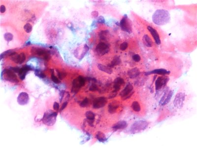 Lesión intraepitelial escamosa de alto grado (HSIL) (9391499542)
