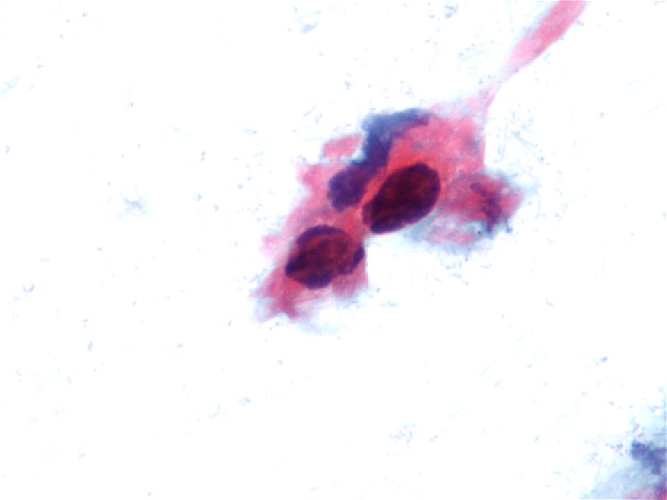 Lesión intraepitelial escamosa de alto grado (HSIL) (9388726581)