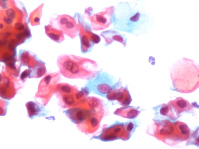 Lesión intraepitelial escamosas de bajo grado (LSIL) (9292563529)
