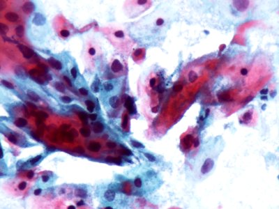 Lesión intraepitelial escamosa de alto grado (HSIL) (9388726527)