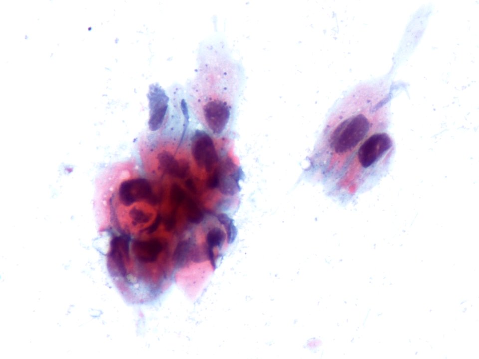 Lesión intraepitelial escamosa de alto grado (HSIL) (9391499282)