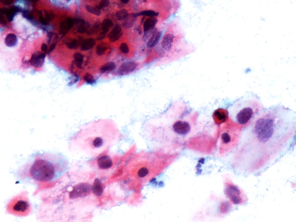 Lesión intraepitelial escamosa de alto grado (HSIL) (9391499414)