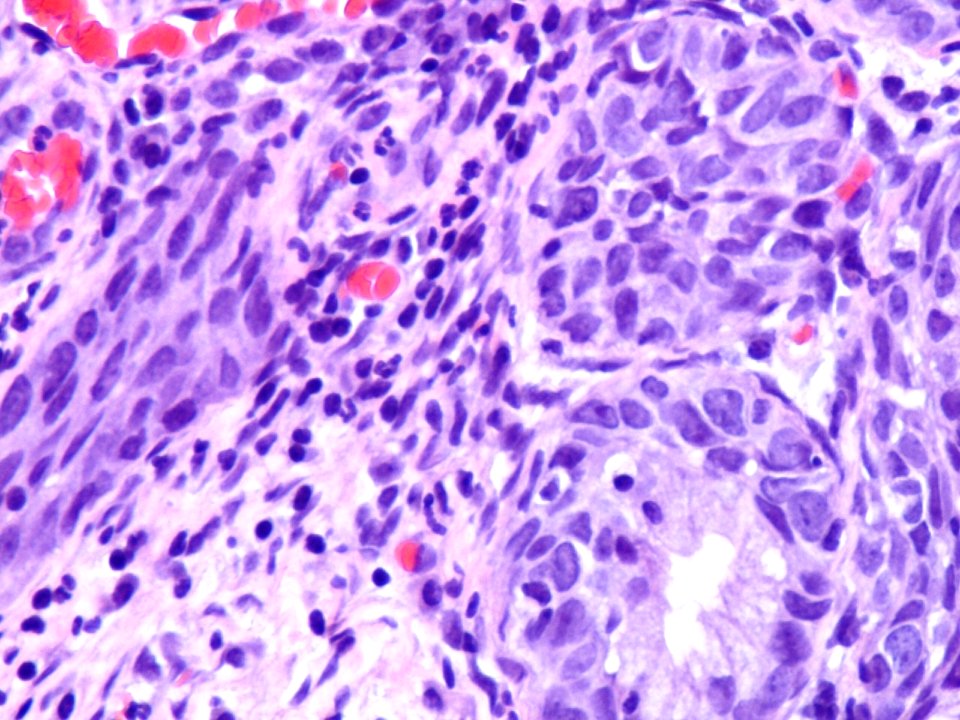 Lesión intraepitelial escamosa de alto grado (HSIL) (9318572163)